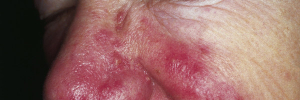 Rosacea Optimized